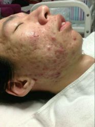 -苗方清颜专业祛痘