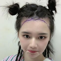 -碧莲盛·不剃发植发