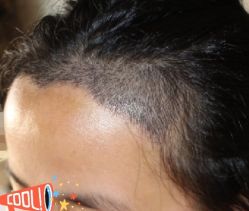 -大麦微针植发丨全国连锁