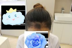 -大麦微针植发丨全国连锁