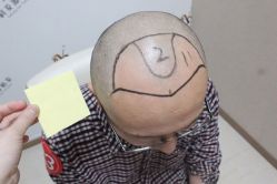 点击看大图 -大麦微针植发丨全国连锁