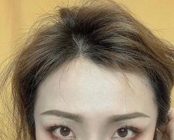 点击看大图 -碧莲盛·不剃发植发