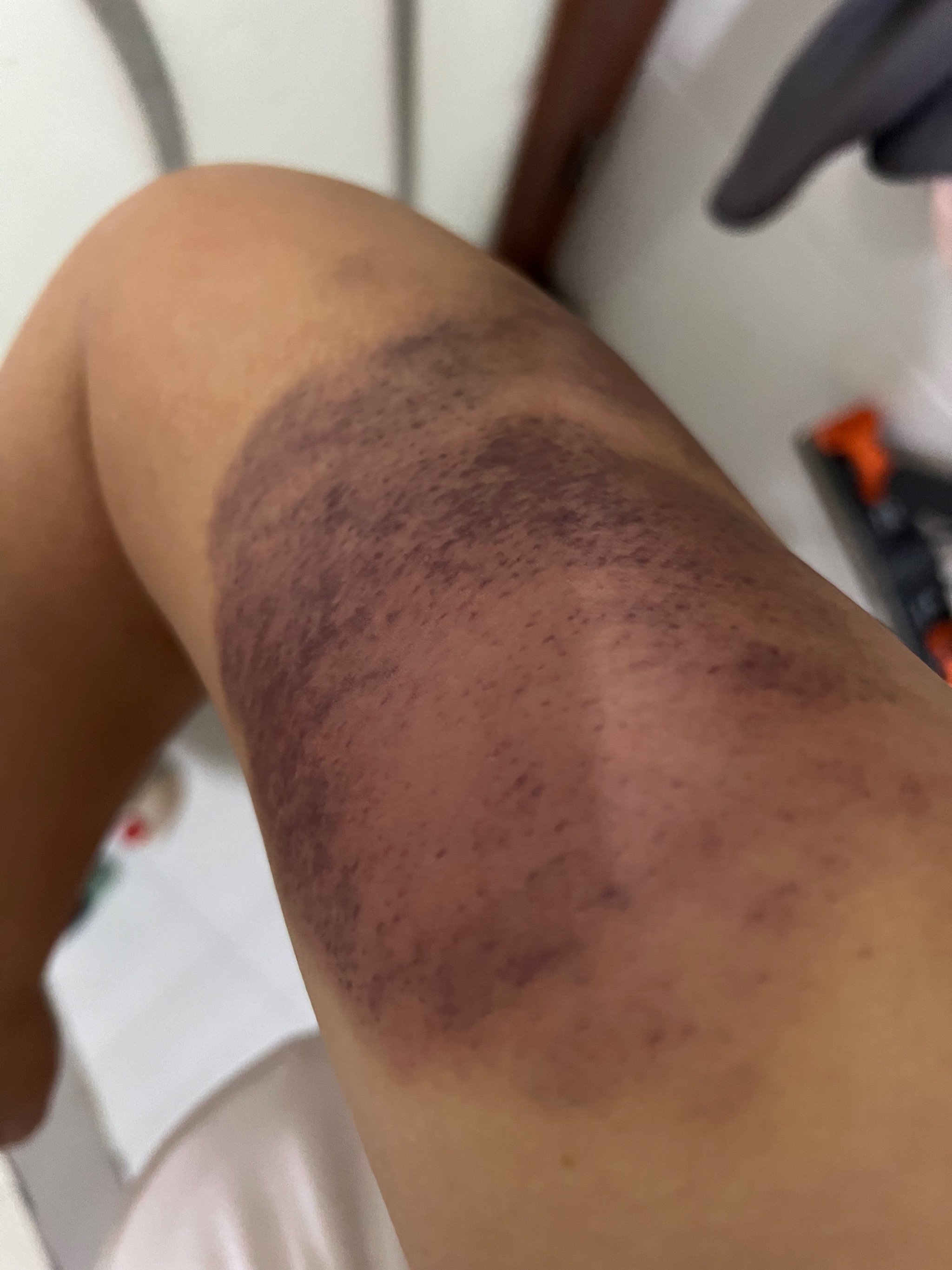 做完筋膜刀手臂淤青发紫了,好疼,正常不?
