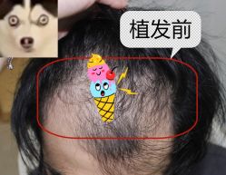 -大麦微针植发全国连锁