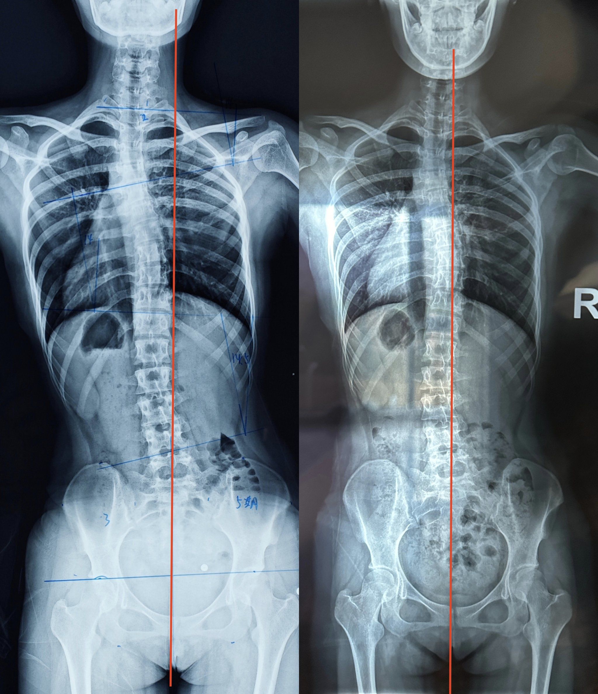 成长轨迹:骨骼x光对比