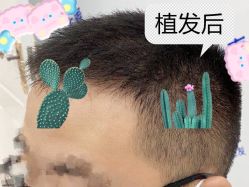 -大麦微针植发全国连锁