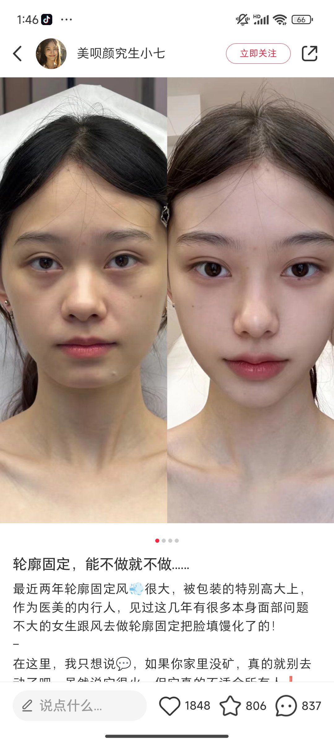 高颧骨还有点外扩,适合去做轮廓吗?