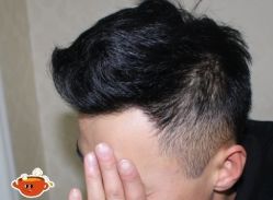 -大麦微针植发丨全国连锁