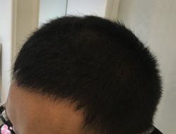 -大麦微针植发丨全国连锁