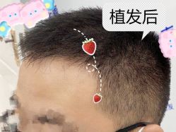 -大麦微针植发全国连锁