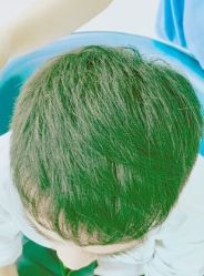 -大麦微针植发丨全国连锁