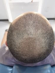 -大麦微针植发全国连锁