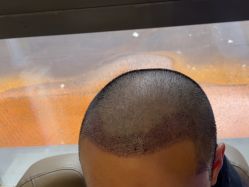 -碧莲盛·不剃发植发