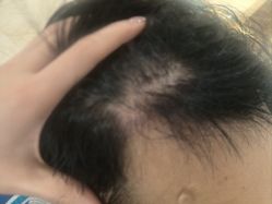 -碧莲盛·不剃发植发