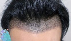 -大麦微针植发丨全国连锁