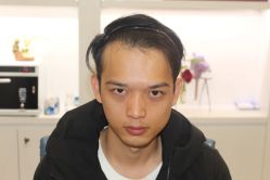 点击看大图 -大麦微针植发丨全国连锁