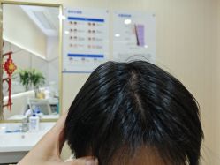 -碧莲盛·不剃发植发