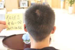 点击看大图 -大麦微针植发丨全国连锁