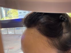 -碧莲盛·不剃发植发