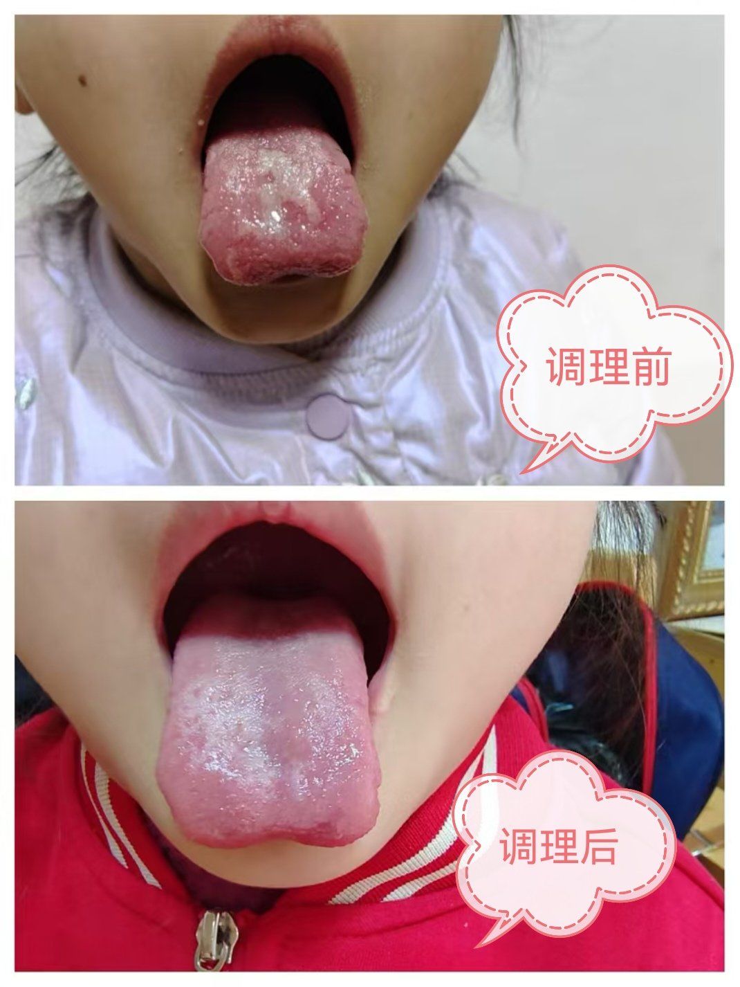比同龄孩子矮半头,经朋友介绍来店里综合调理,舌头起了翻天覆地的变化