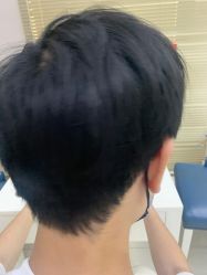 体验后-大麦微针植发丨全国连锁