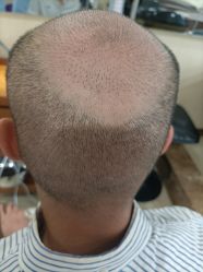 -碧莲盛·不剃发植发