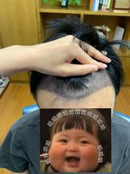 -大麦微针植发全国连锁