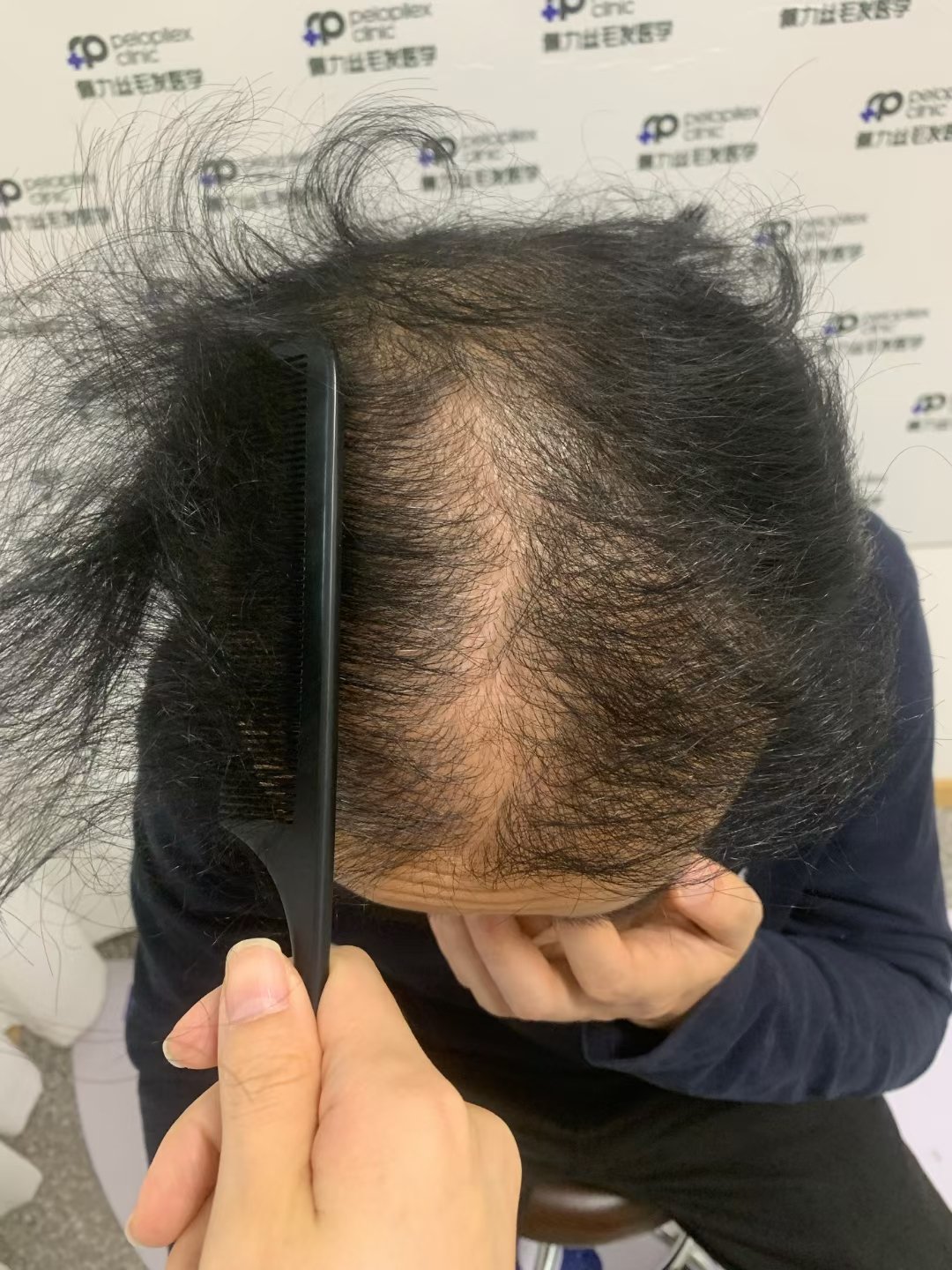 植发哪里有治(植发去哪里正规)