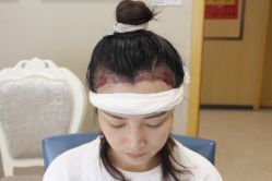 -大麦微针植发丨全国连锁