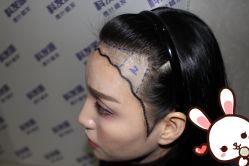 点击看大图 -大麦微针植发丨全国连锁