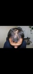-大麦微针植发丨全国连锁