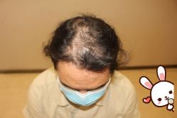 -大麦微针植发丨全国连锁