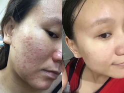 -苗方清颜痘肌研究所