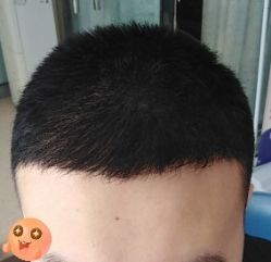 -大麦微针植发丨全国连锁