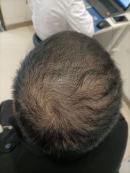 -大麦微针植发丨全国连锁