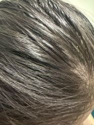 -碧莲盛·不剃发植发