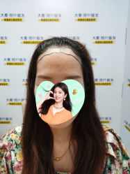 -大麦微针植发丨全国连锁