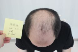 -大麦微针植发丨全国连锁