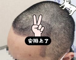 -大麦微针植发全国连锁