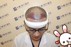 点击看大图 -大麦微针植发丨全国连锁