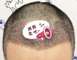 -大麦微针植发全国连锁