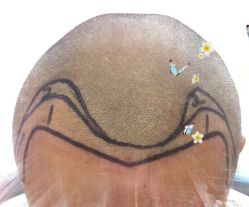 -大麦微针植发全国连锁