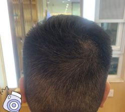 -大麦微针植发丨全国连锁