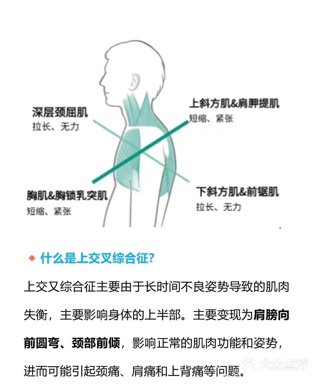 上交叉综合症如何改善呢?