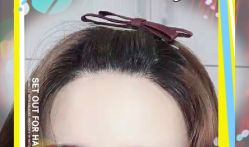 -大麦微针植发全国连锁