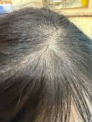 -碧莲盛·不剃发植发