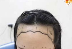-大麦微针植发全国连锁