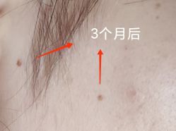 -痣缘宫