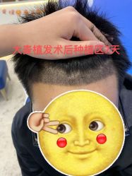 -大麦微针植发全国连锁