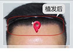 -大麦微针植发全国连锁